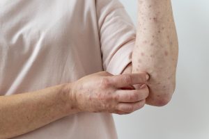 Pessoa com lesões na pele do braço, um dos sintomas da varíola dos macacos